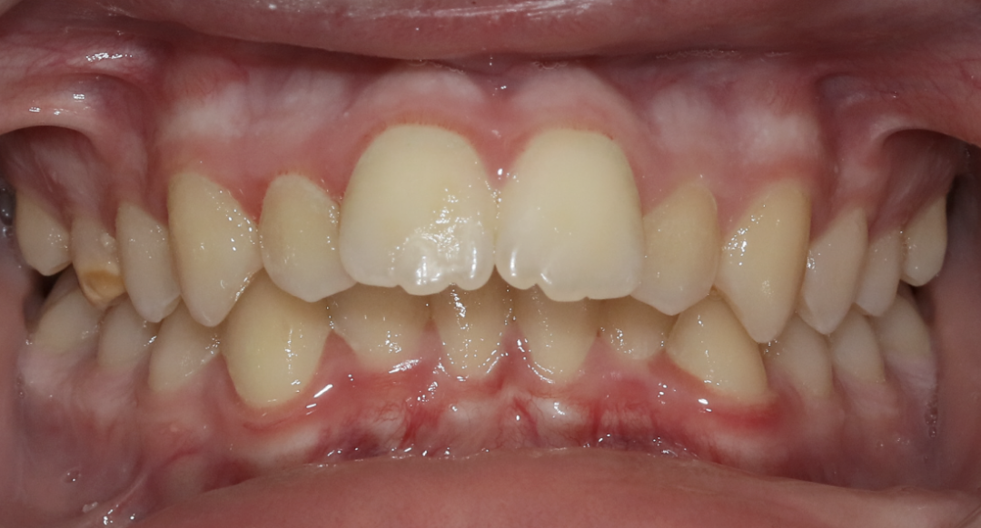 Aligner tray illustration